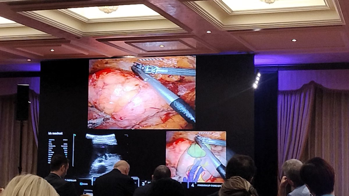 Angelo Mottaran (@angelomottaran) on Twitter photo Fantastic first Robot Assisted Partial Nephrectomy Augmented Reality 3D model guided and with automatic AI surgical phases, organs and instruments recognition <a href="/pidebacker/">Pieter De Backer</a> performed during #AI2M by <a href="/riccardoschiav6/">riccardo schiavina</a> at Sant’Orsola Hospital Urology Department <a href="/Eugenio74446325/">Eugenio Brunocilla</a>. Fantastic first Robot Assisted Partial Nephrectomy Augmented Reality 3D model guided and with automatic AI surgical phases, organs and instruments recognition <a href="/pidebacker/">Pieter De Backer</a> performed during #AI2M by <a href="/riccardoschiav6/">riccardo schiavina</a> at Sant’Orsola Hospital Urology Department <a href="/Eugenio74446325/">Eugenio Brunocilla</a>.