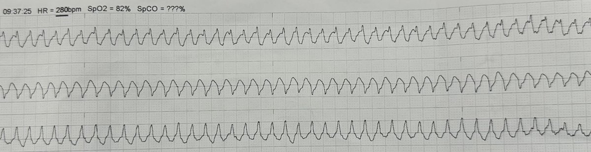 smithECGBlog's tweet photo. Syncope while on a treadmill

https://t.co/UgUgXKyaPL https://t.co/YM91PHH85p