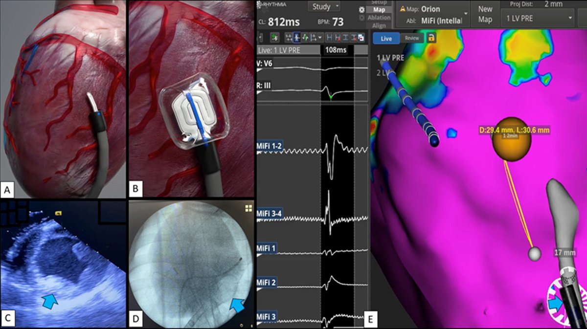 Efficacy of Balloon Expandable Extreme-Low Temperature Ventricular Epicardial Cryoablation: A Preclinical Proof of Concept Evaluation <a href="/CleClinicHVTI/">Cleveland Clinic Heart, Vascular & Thoracic</a> <a href="/ioanliuba/">Ioan Liuba</a> <a href="/arwayounis2/">Arwa Younis MD</a> <a href="/omwazni/">Oussama Wazni</a> heartrhythmjournal.com/article/S1547-…