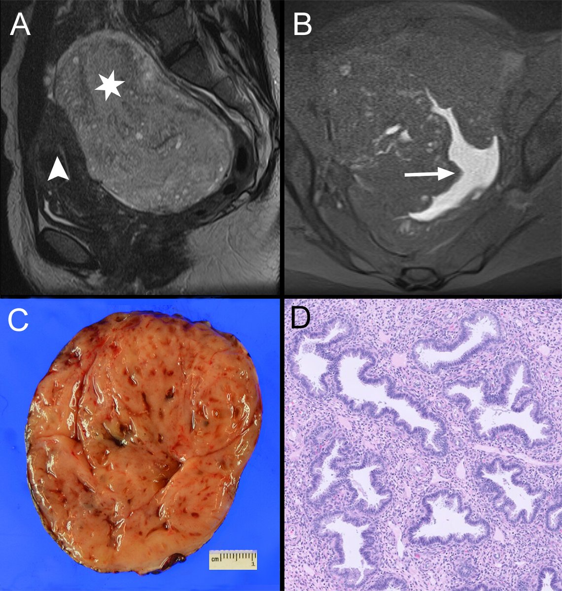 Radiology (@radiology_rsna) on Twitter photo Endometriosis: MRI and US protocols with expert image interpretation are essential for accurate diagnosis and to prevent delays in patient care. <a href="/MayoRadiology/">Mayo Clinic Radiology</a> @mayogynecology <a href="/JeffersonRads/">Jefferson Radiology</a> bit.ly/4demsy7 Endometriosis: MRI and US protocols with expert image interpretation are essential for accurate diagnosis and to prevent delays in patient care. <a href="/MayoRadiology/">Mayo Clinic Radiology</a> @mayogynecology <a href="/JeffersonRads/">Jefferson Radiology</a> bit.ly/4demsy7