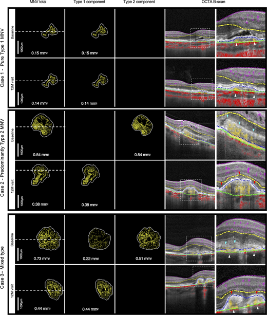 IOVS Journal (@arvoiovs) on Twitter photo Kotaro Tsuboi et al. <a href="/kotaroT84/">Kotaro Tsuboi(坪井 孝太郎)</a> <a href="/CaseyEye/">OHSU Casey Eye</a> present a Quantitative Evaluation of Type 1 and Type 2 Choroidal Neovascularization Components Under Treatment With Projection-Resolved Optical Coherence Tomography Angiography, iovs.arvojournals.org/article.aspx?a…. Kotaro Tsuboi et al. <a href="/kotaroT84/">Kotaro Tsuboi(坪井 孝太郎)</a> <a href="/CaseyEye/">OHSU Casey Eye</a> present a Quantitative Evaluation of Type 1 and Type 2 Choroidal Neovascularization Components Under Treatment With Projection-Resolved Optical Coherence Tomography Angiography, iovs.arvojournals.org/article.aspx?a….