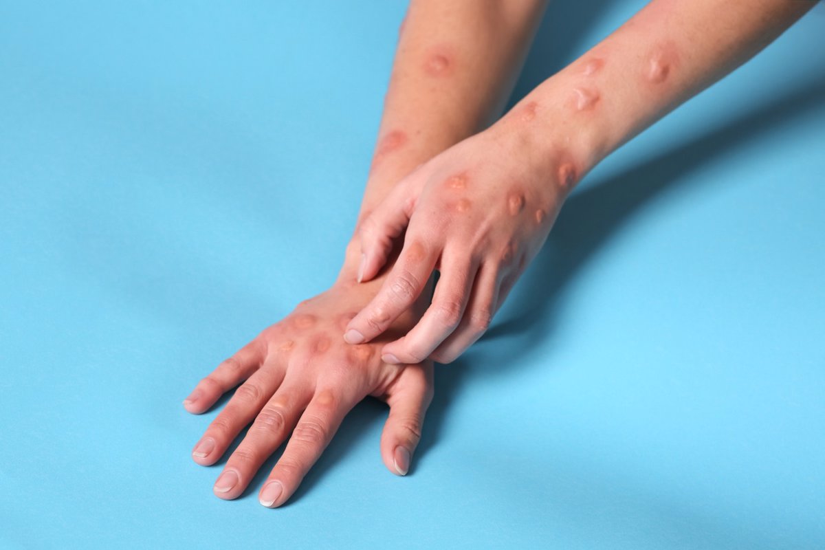 CLINICASTOMA's tweet photo. Europa experimenta un aumento del 50% de los casos de mpox en agosto en comparación con julio https://t.co/0DSeHGXD9U https://t.co/78RHs2EsEA