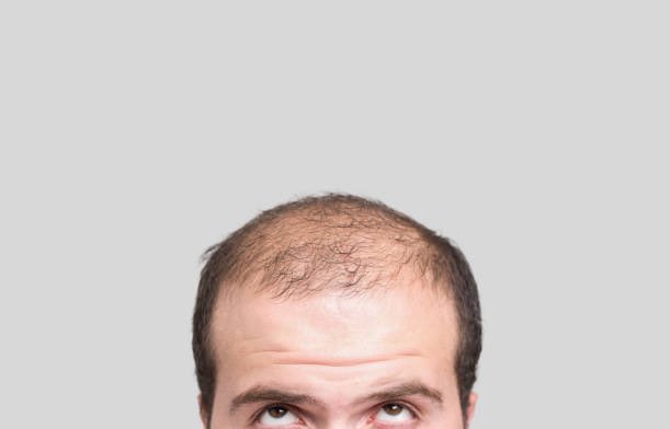 safonyameherbal's tweet photo. You can’t be bald forever 🤝

For BALDNESS and HAIR GROWTH, roast the dried seed of neem + its fresh leaves to obtain the oil, mix the oil with shea butter and apply on the part of interest twice daily… 🌿Those interested in cosmetics can utilize this as a business https://t.co/GE0FeDkoHU