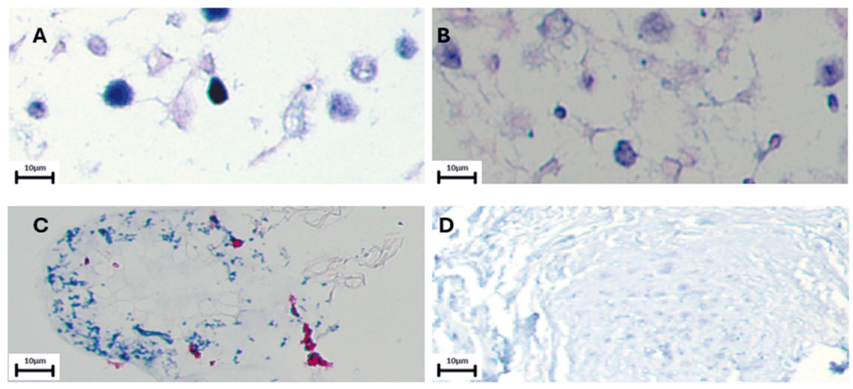 Juliogen's tweet image. 😱 EBV, a virus linked to lymphomas and cancers, may also play a role in lung cancer progression! Our study found EBV in 23% of lung carcinomas and linked the BARF1 protein to increased cell migration and invasion. 🦠🔬 #lungcancer #EBV #research"  mdpi.com/2073-4409/13/1…