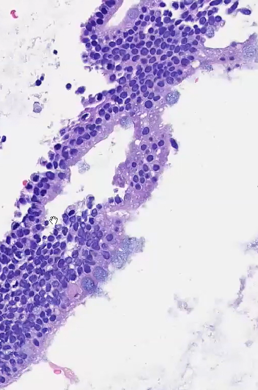 Janiranavarro's tweet image. Mucinous lesions of the endometrium
-60 yo female with hydrometra
-Endometrial biopsy with glands with mucin cells, goblet cells and red granules (last 2 pics)
IHC: ER neg. PAX-8, CK7, CDX-2 patchy positive. CK20 focal +. p53 wild type. Chromogranin focally +
How would you sign…