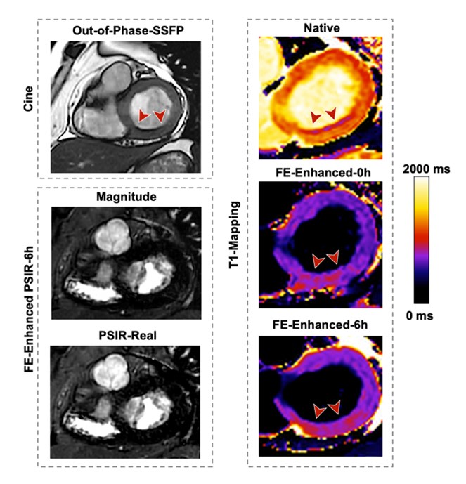 Mismatch Between Native and Ferumoxytol-Enhanced Cardiac Magnetic Resonance Imaging Findings in A Patient with Chronic Myocardial Infarction: Novel Insights into Perfusion Defect <a href="/MD_QiYang/">Qi Yang</a> <a href="/Dr_LiuYuehong/">Yvonne Liu</a> #AHAJournals ahajrnls.org/4eaUC7c