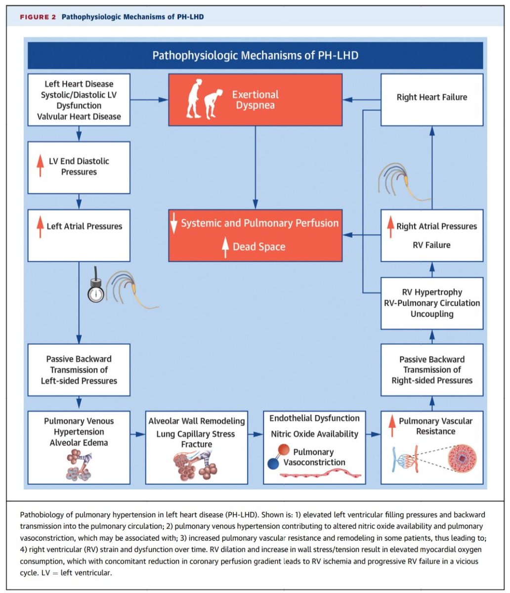 Hipertensión Pulmonar asociada a cardiopatía. 🫀💥🫁 
✨️State-Of-The-Art Review <a href="/JACCJournals/">JACC Journals</a> 💯👌🏻
🔷️La HP asociada a cardiopatía (grupo 2) es la forma más frecuente de HP y representa entre el 65-80%.
🔷️Definición hemodinámica: PAPm >20 mmHg, PAWP >15 mmHg; PAVR <2 WU