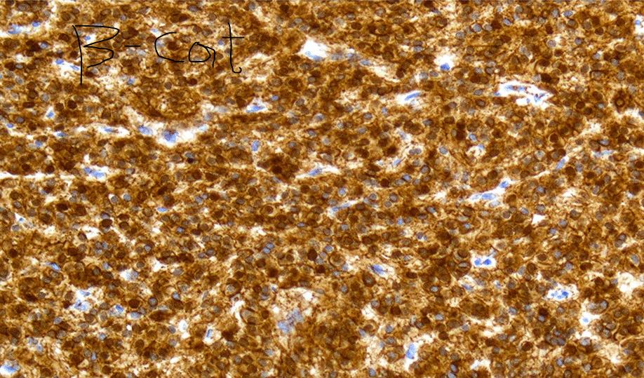 This is a case a pseudoendocrine sarcoma, currently thought to be an intermediate-grade sarcoma with a propensity to arise in paravertebral soft tissues of older patients. Negative for NE markers. Can show patchy S100 and nuclear beta-catenin.

Photos excerpted from: