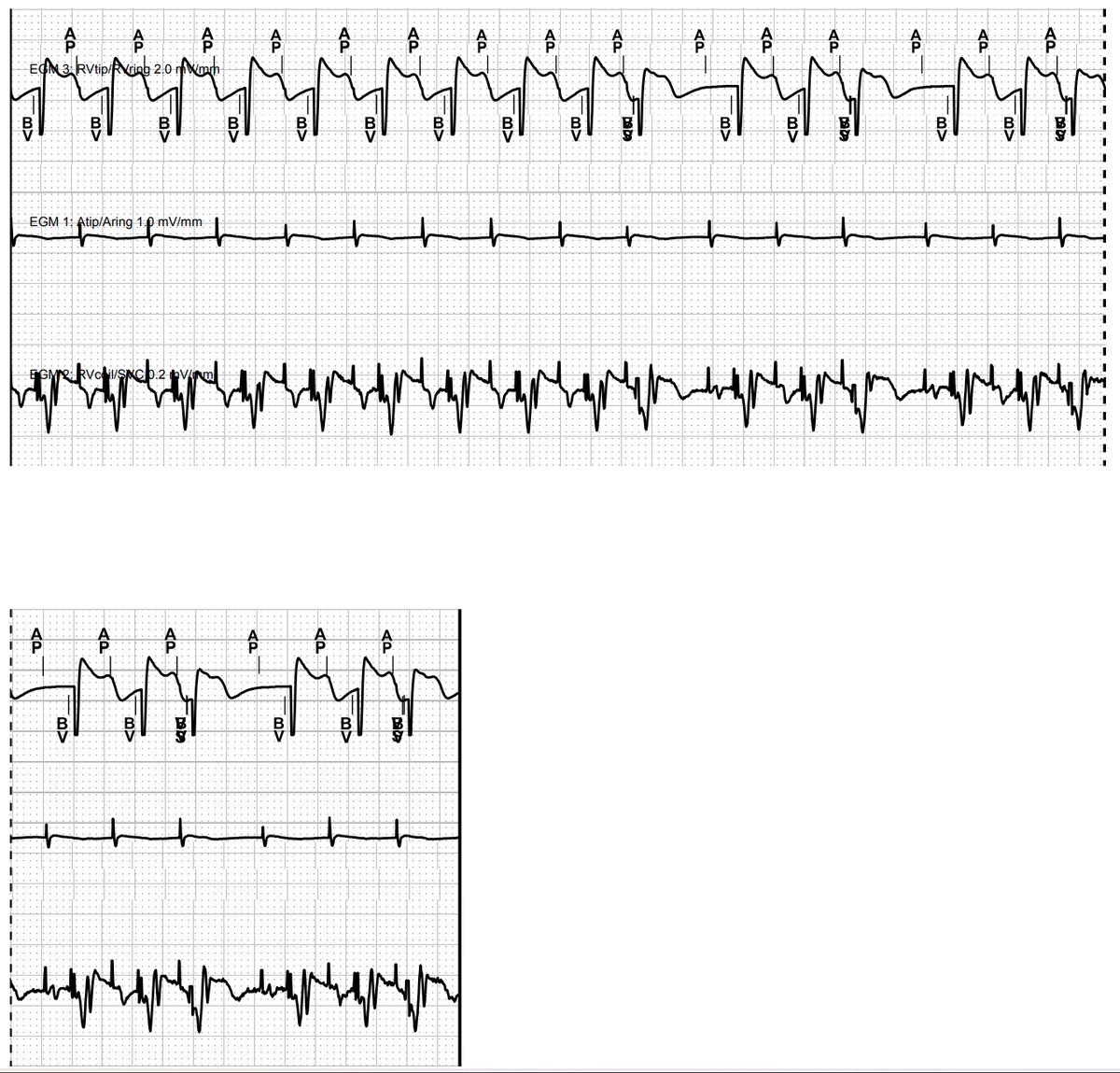 I am getting so fed up with the <a href="/Medtronic/">Medtronic</a> TWOS issues... but at least I discovered a new amazing variation to share with you folks <a href="/narrowQRS/">JMC</a>
