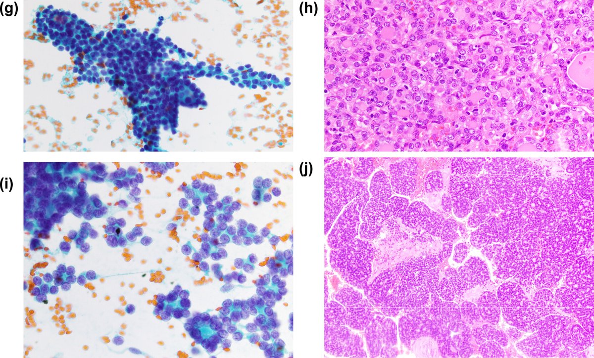 Cancer Cytopathology (@cancercytopath) on Twitter photo ā”DICER1 and PTEN FNAs reveal many cytologic similarities. DICER1 patients are younger, and PTEN patients had multinodular disease. Awareness of these genetic cohorts can identify patients at risk for thyroid cancer.
acsjournals.onlinelibrary.wiley.com/doi/full/10.10ā¦
<a href="/bfaquin/">WC Faquin, MD, PhD</a> <a href="/aakasharmand/">Zubair Baloch</a> #CytoPath ā”DICER1 and PTEN FNAs reveal many cytologic similarities. DICER1 patients are younger, and PTEN patients had multinodular disease. Awareness of these genetic cohorts can identify patients at risk for thyroid cancer.
acsjournals.onlinelibrary.wiley.com/doi/full/10.10ā¦
<a href="/bfaquin/">WC Faquin, MD, PhD</a> <a href="/aakasharmand/">Zubair Baloch</a> #CytoPath