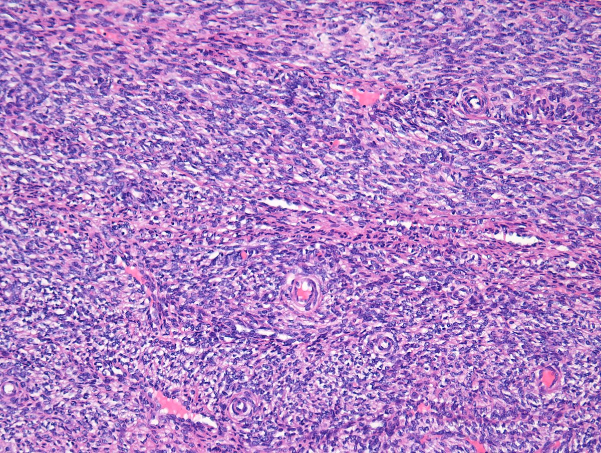 Middle-aged female.

Let's play the #tooclosetodiagnose game.

Hit me with your excellent differentials 😎 #PathTwitter folks.

<a href="/RibianszkyA/">Annamária Ribiánszky, MD</a> <a href="/DanGrahamMD/">Dan Graham</a> <a href="/Immanuel_Paul30/">Immanuel Paul</a> <a href="/Kenny92954457/">Kenny De Gracia T.</a>