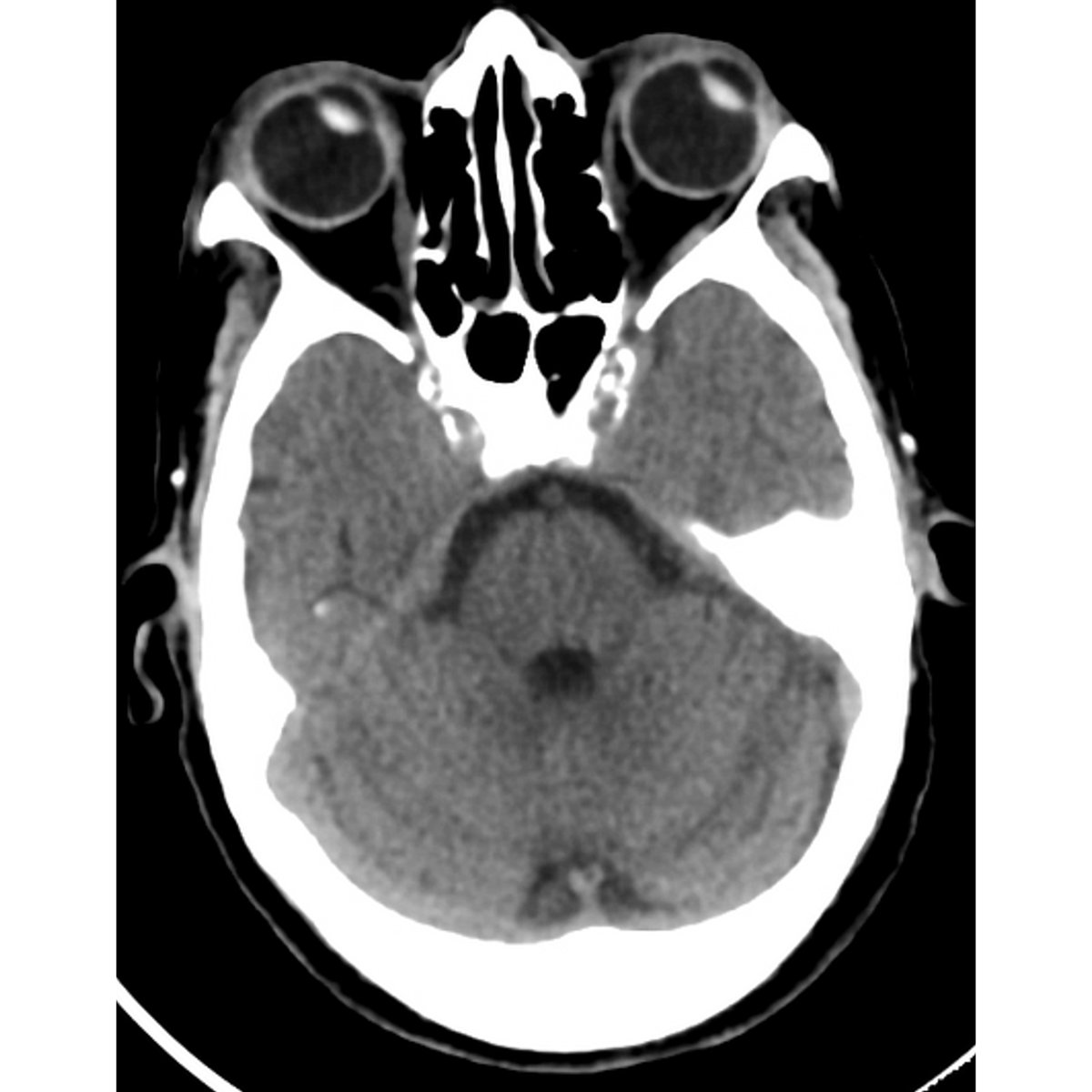 Prévost sign!

aka Vulpian sign

"conjugate eye deviation in patients with acute stroke"

Jean Louis Prévost
Swiss physician (1838-1927)

- hemispheric stroke eyes deviate ipsilaterally towards the stroke (i.e. contralateral to the hemiparesis) 2/2 frontal eye fields involvement