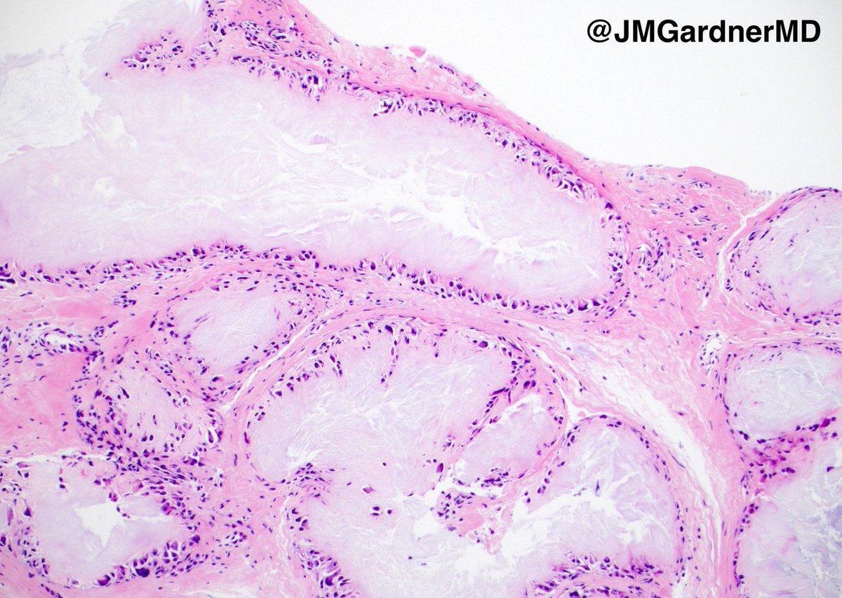 A #pathology classic! Touch prep and H&amp;E section. What's your diagnosis? Click here for answer with video: kikoxp.com/posts/3799 #Pathology #dermpath #dermatology #dermatologia #dermtwitter #BSTpath