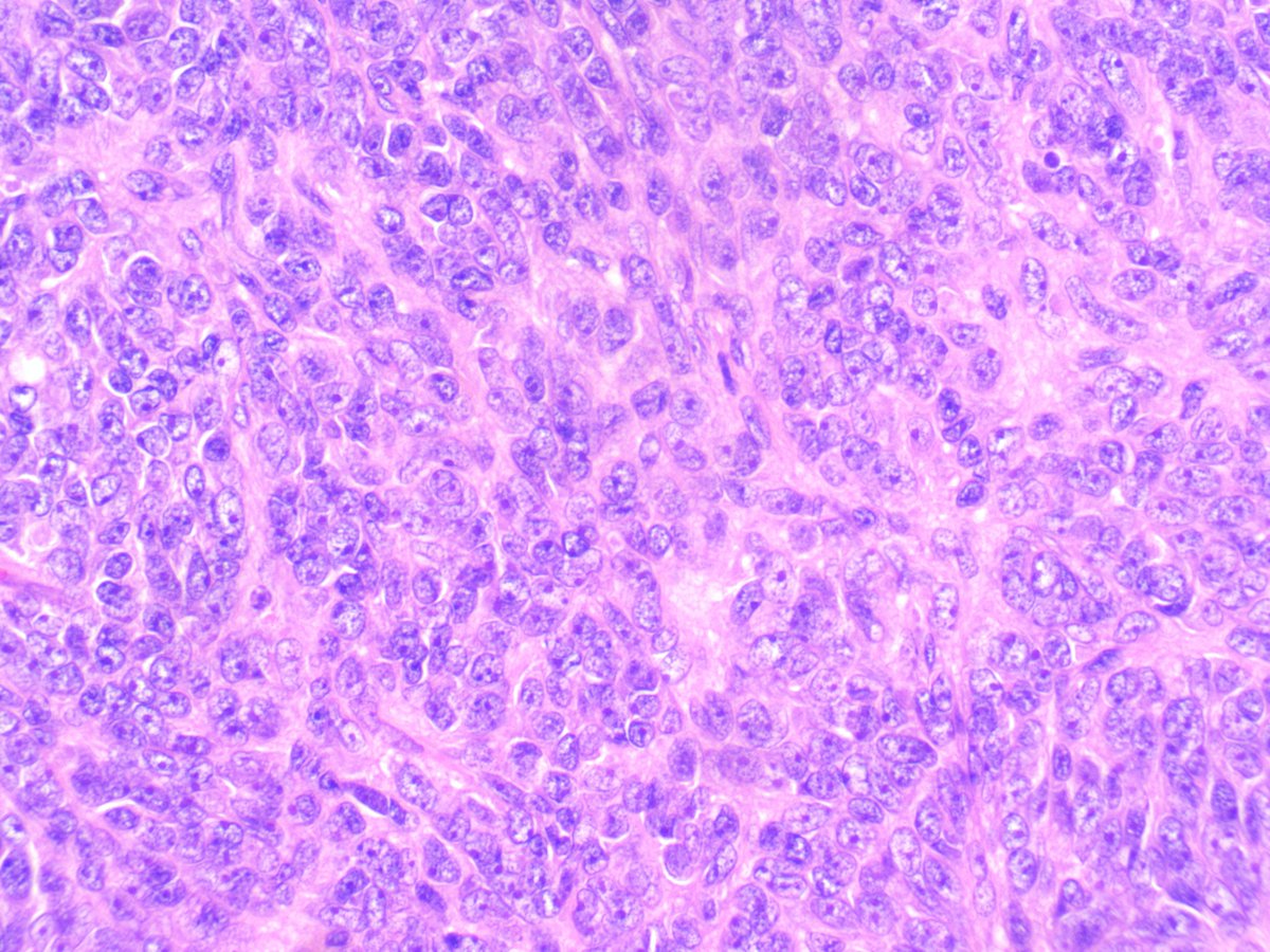 Case of the week: A 37-year-old male presents with severe abdominal pain and vomiting. Imaging shows intestinal mass. Tumor cells are positive for S100 and synaptophysin and negative for keratins. Diagnosis?