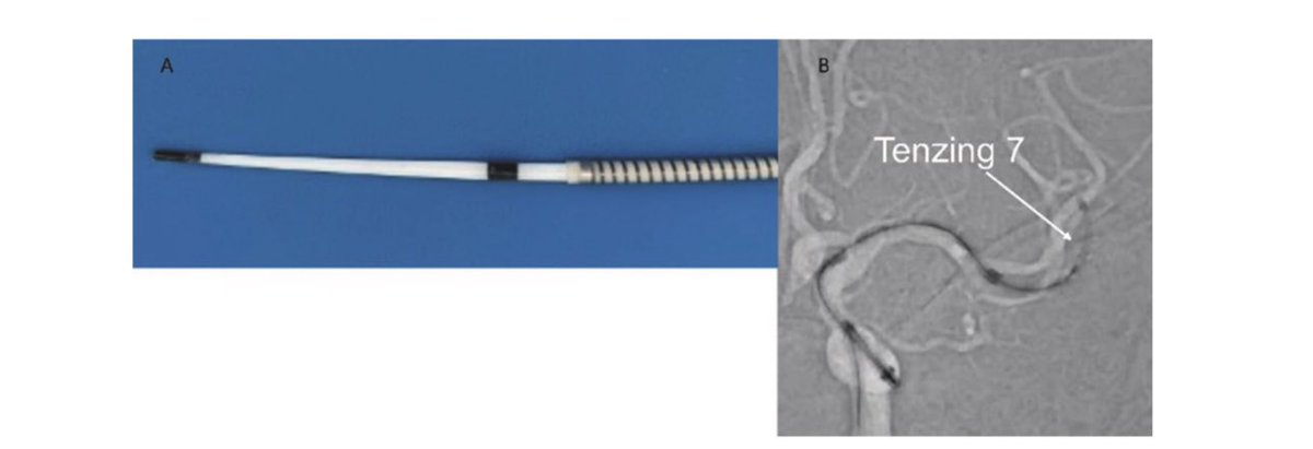 Mubashir Pervez (@mubashir_pervez) on Twitter photo Sharing our latest: Tenzing-plasty- a tool & technique which is useful in managing nasty ICADs. 🚨🧠 jnis.bmj.com/content/neurin…
<a href="/gdabus/">Guilherme Dabus, MD</a> <a href="/SNISinfo/">SNIS Info</a> <a href="/route92med/">Route 92 Medical</a> Sharing our latest: Tenzing-plasty- a tool & technique which is useful in managing nasty ICADs. 🚨🧠 jnis.bmj.com/content/neurin…
<a href="/gdabus/">Guilherme Dabus, MD</a> <a href="/SNISinfo/">SNIS Info</a> <a href="/route92med/">Route 92 Medical</a>