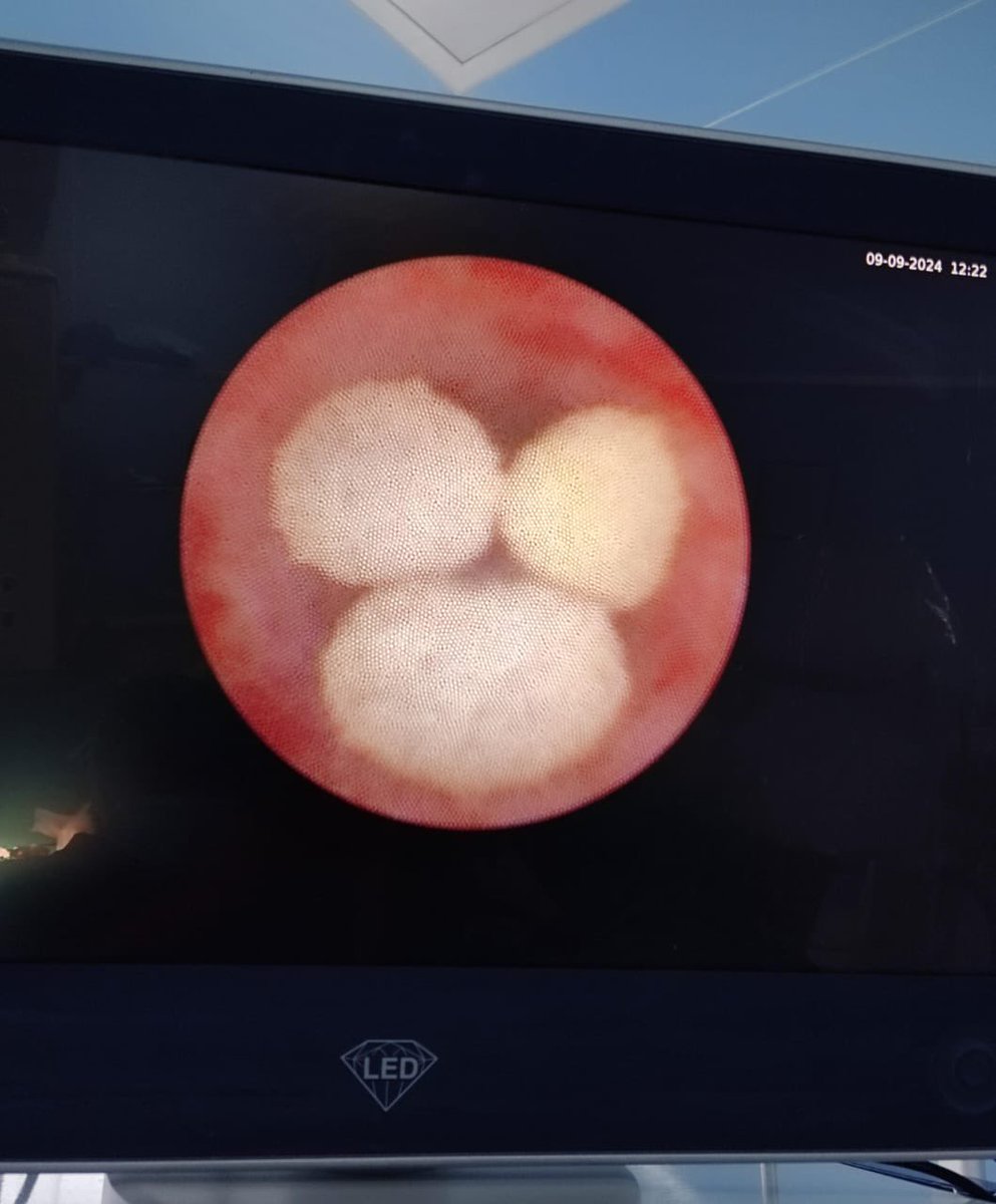 ShashankaDr's tweet photo. Met Mickey in the ureter today 😂 https://t.co/WrKvALIEXg