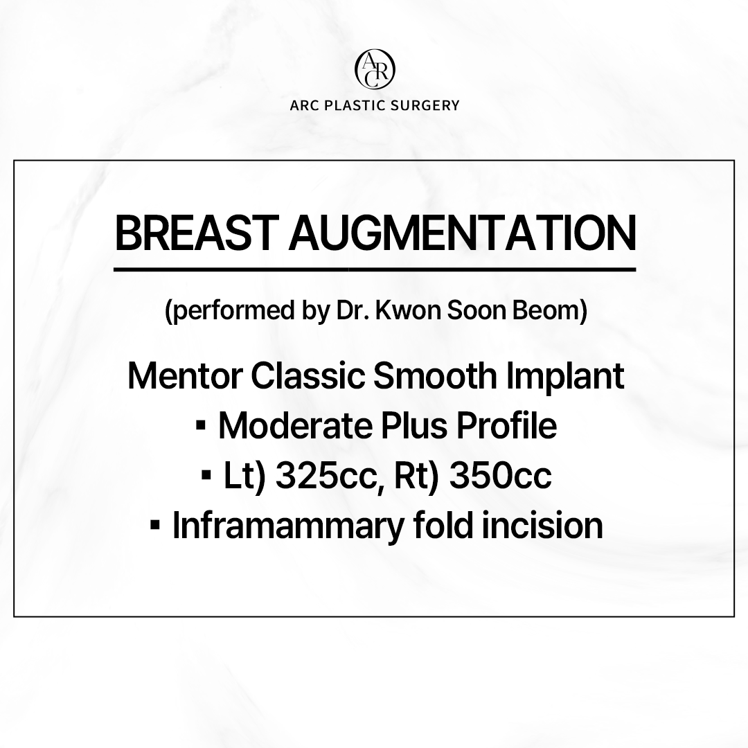 dr_kwonsoonbeom's tweet photo. [FINE ARC]
Breast Augmentation Surgery
***
Mentor Classic Smooth Implant
: Moderate Plus Profile
- Lt) 325cc, Rt) 350cc
- Inframammary fold incision
***
#arcplasticsurgery #drkwonsoonbeom #아크성형외과 #アーク整形外科 #breastaugmentation #breastsurgery #boobjob #breastimplant https://t.co/5YTWa74Ieq