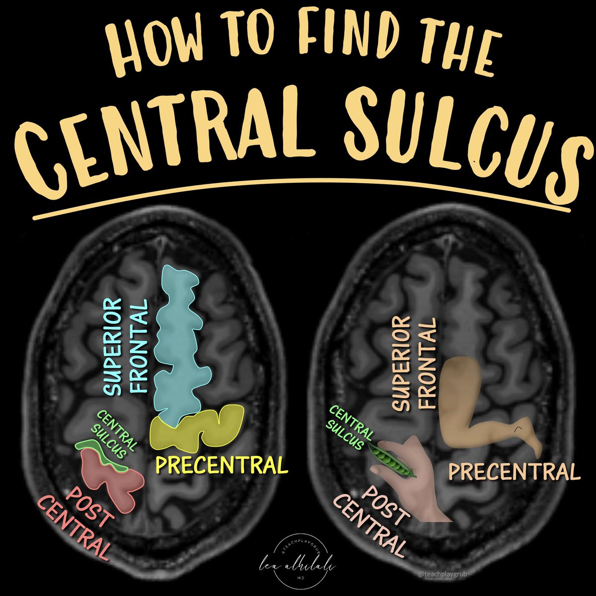 1/Nothing is more CENTRAL to reading an MRI than finding the CENTRAL sulcus?

How do YOU find it?

Are you just using gestalt when you say “frontal” or “parietal”? 

Time to recenter your search pattern with this thread on how to find the central sulcus on a brain MRI!