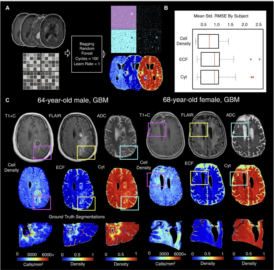 Neurosurgery Publications (@neurosurgerycns) on Twitter photo #NEUNew Noninvasive Autopsy-Validated Tumor Probability Maps Identify Glioma Invasion Beyond Contrast Enhancement bit.ly/47r2xe4 by Bobholz et al <a href="/MedicalCollege/">Medical College of Wisconsin</a> <a href="/IsaacYangMD/">Isaac Yang MD</a> <a href="/CNS_Update/">CNS</a> <a href="/DKondziolkaCNS/">Douglas Kondziolka</a> <a href="/jh_kanterMD/">John Kanter</a> <a href="/LKReedMD/">Laura K. Reed, MD</a> <a href="/e_celano/">Emma Celano</a> <a href="/urquiagajf_MD/">Jorge F. Urquiaga</a> <a href="/Zaazoue/">Mohamed Zaazoue</a> #NEUNew Noninvasive Autopsy-Validated Tumor Probability Maps Identify Glioma Invasion Beyond Contrast Enhancement bit.ly/47r2xe4 by Bobholz et al <a href="/MedicalCollege/">Medical College of Wisconsin</a> <a href="/IsaacYangMD/">Isaac Yang MD</a> <a href="/CNS_Update/">CNS</a> <a href="/DKondziolkaCNS/">Douglas Kondziolka</a> <a href="/jh_kanterMD/">John Kanter</a> <a href="/LKReedMD/">Laura K. Reed, MD</a> <a href="/e_celano/">Emma Celano</a> <a href="/urquiagajf_MD/">Jorge F. Urquiaga</a> <a href="/Zaazoue/">Mohamed Zaazoue</a>
