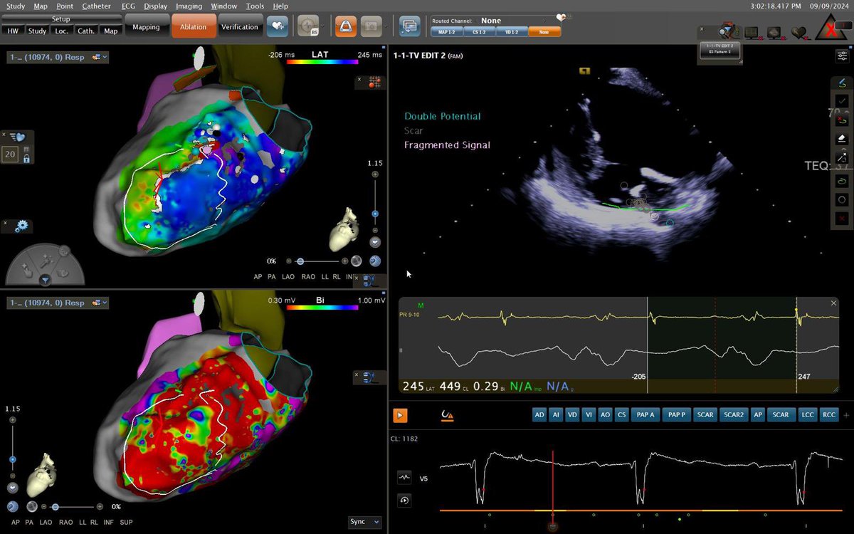 ArritmiasHULA's tweet photo. Electrical storm on patient with ischemic cardiomyopathy. Refractory to ICD shocks. Activation map of the clinical VT and successful ablation. #CARTO #CardiologíaHULA #SOUNDSTAR https://t.co/356uMapCOA