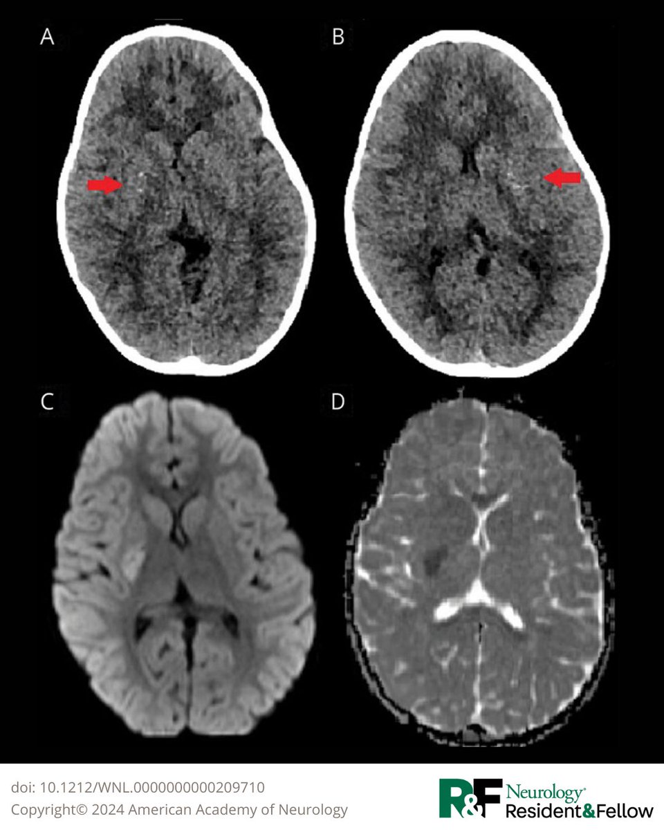 Basal ganglia ischemic stroke is a rare but known complication of minor head trauma in young children. Learn more in this Teaching NeuroImage article: bit.ly/3Zbmdk1

#NeurologyRF