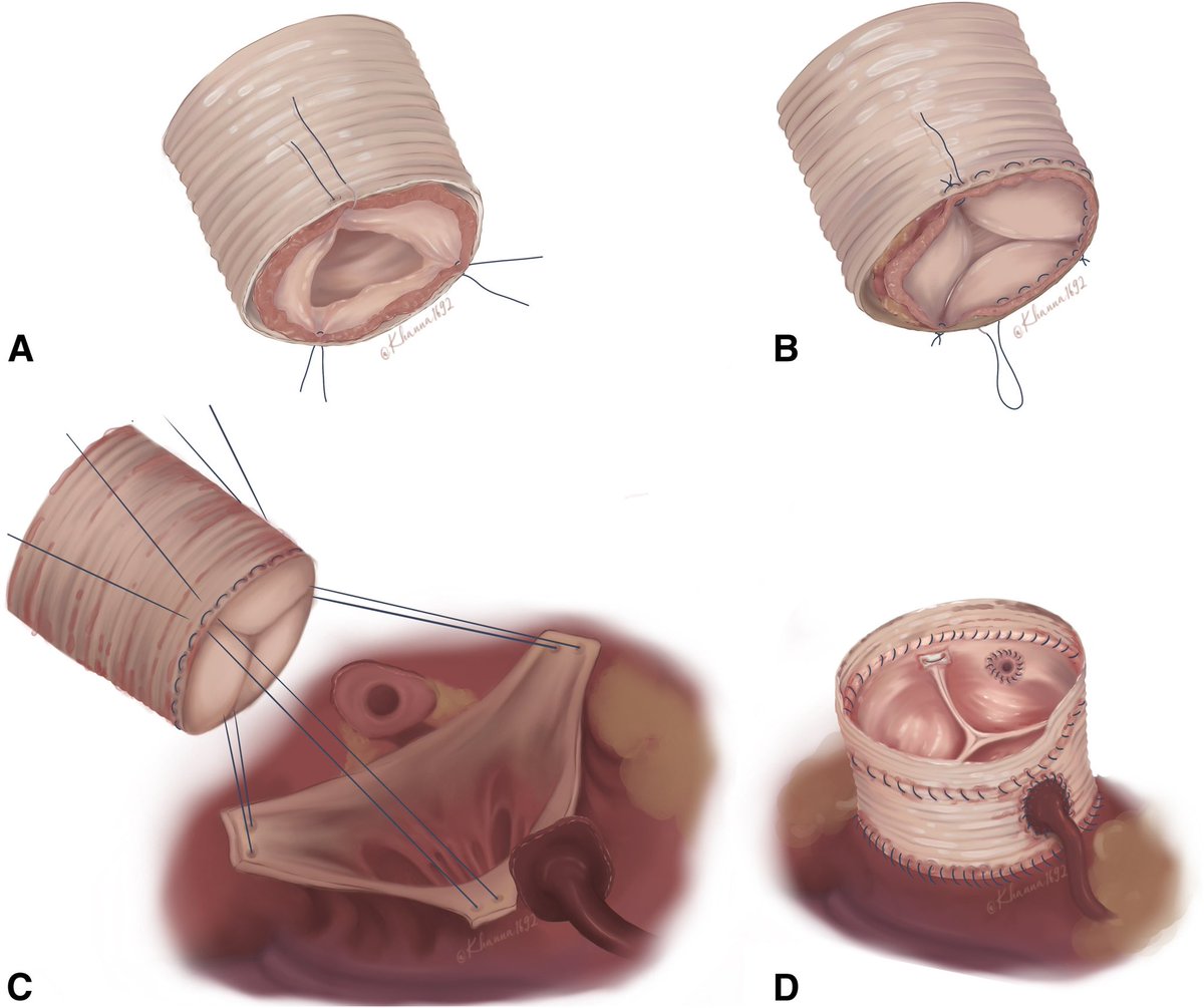 Ross procedure through mini access
Go check the video
#ross #ministernotomy #mics #aorticvalve 

jtcvstechniques.org/article/S2666-…