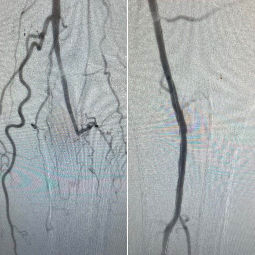 UMSOM and the Division of Vascular Surgery are now the 1st in the state to use an absorbable, drug-eluting scaffold to treat below-the-knee disease in patients with CLTI in our Baltimore Outpatient Endovascular Lab! <a href="/KNagarshethMD/">KJ Nagarsheth MD, MBA, FACS</a> #Esprit #Surgery #Vascular <a href="/AbbottNews/">Abbott</a>