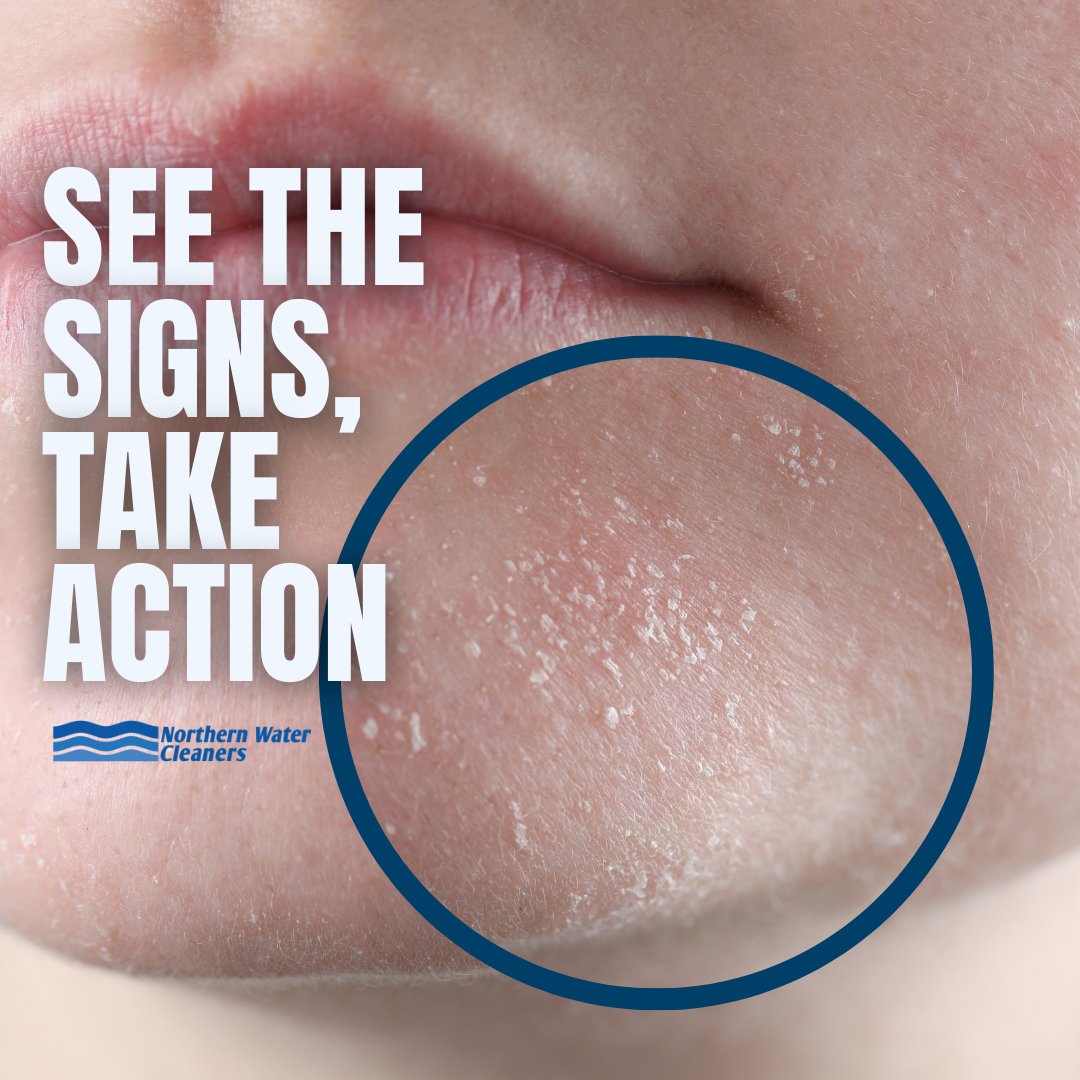 Notice your skin feeling dry after showering? 

This is your sign to install a cleaning and filter system in your home—because it could be the water that’s causing your dry skin!

#citymj #dryskin #watersystem #cleanwater #saskatchewan #alberta