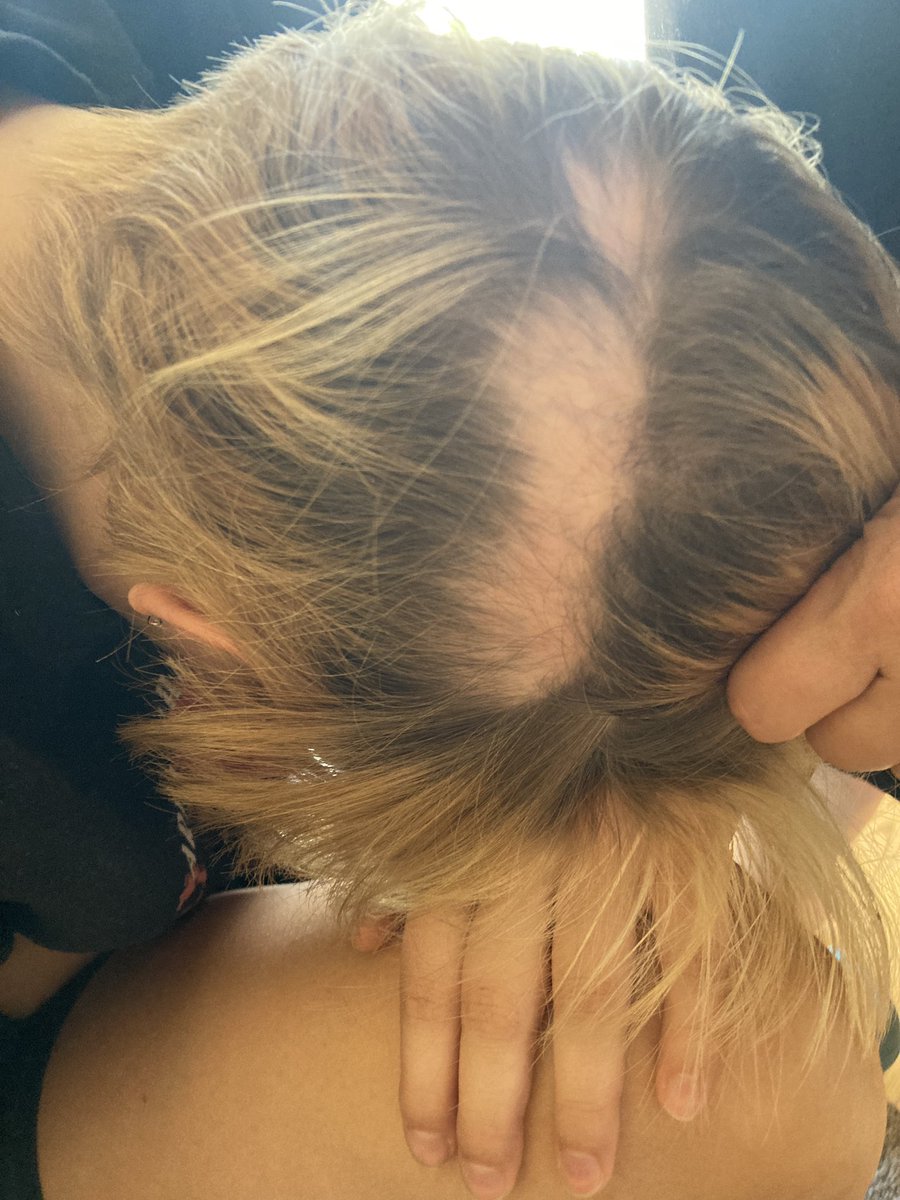 September is #AlopeciaAreata awareness month. My spots showed up in 2nd grade. The difference for me is, no one ever knows, because my other hair always covers it. It's always been there. Even when Mythbusting, Inventing, Making. 💪