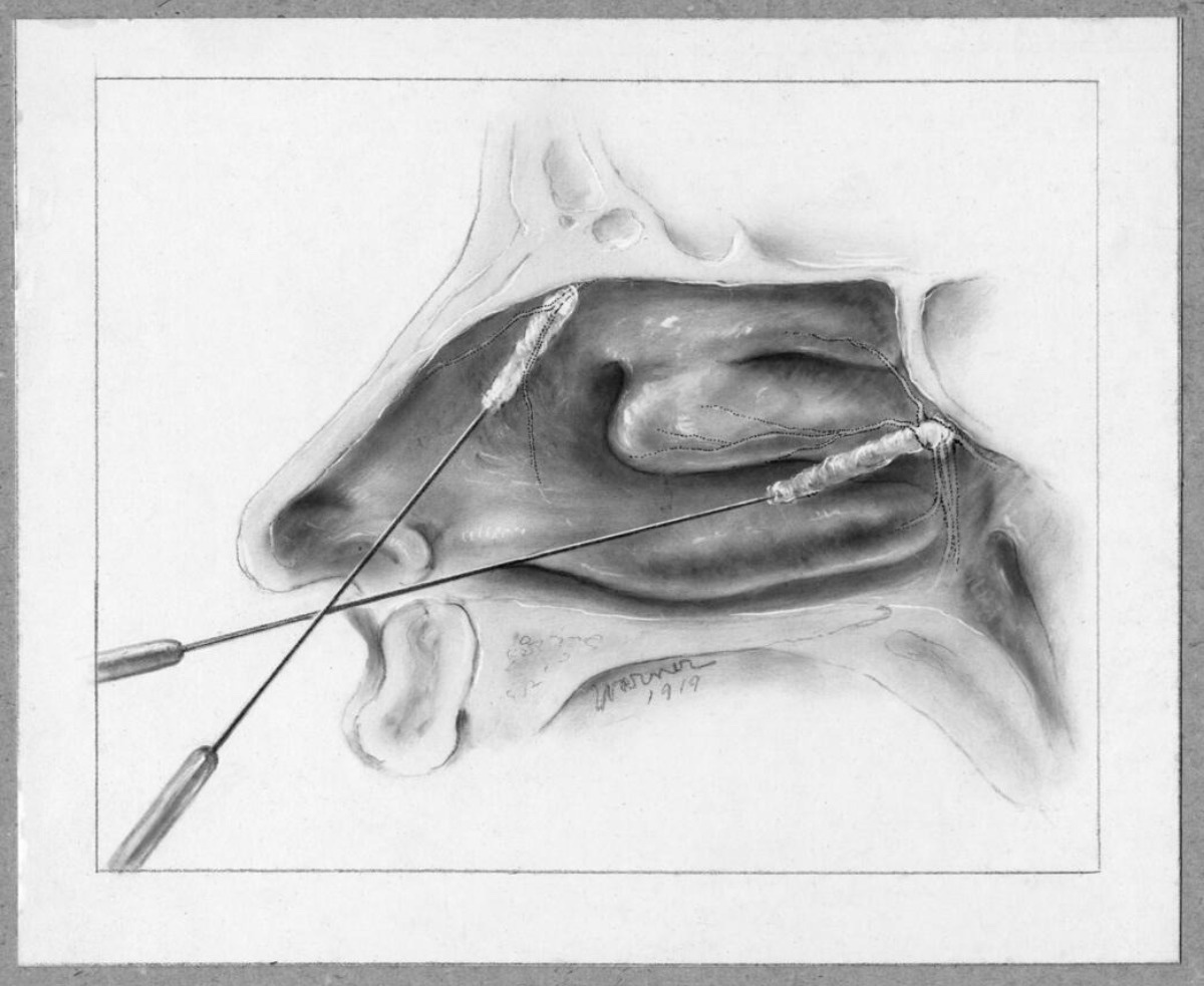 Does nasal mucosal preparation (topical epinephrine vs. topical cocaine with injection of lidocaine containing epinephrine) affect postoperative anesthetic outcomes in endoscopic sinus surgery?

Click to read more: bit.ly/3XC5FAk

#MayoClinicENTResearch #MedTwitter