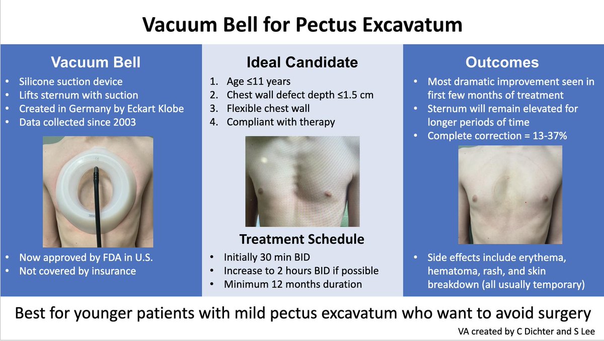 Learn more about the use of the vacuum bell for pectus excavatum with this visual abstract. #APSALearning