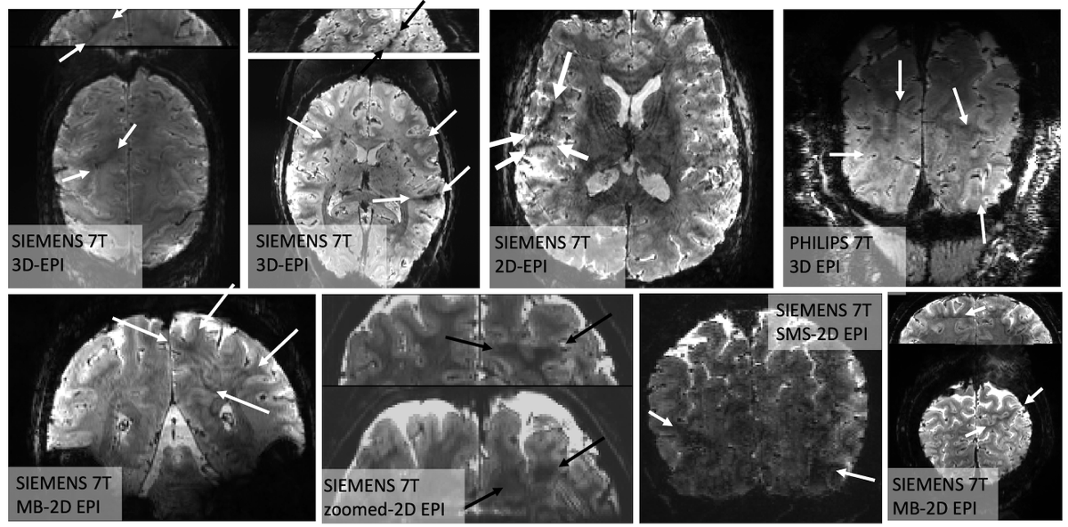 layerfMRI's tweet photo. New layer-fMRI manuscript focusing on Fuzzy Ripple artifacts. Arguably the biggest challenge in layer-fMRI acquisition.

Every layer-fMRI dataset has them, they limit resolution and TR, and we shows how to mitigate them.

https://t.co/VMO2Zfu8hc

#Layer_fMRI_Artifact_of_the_Week https://t.co/yL9iwZb6PL
