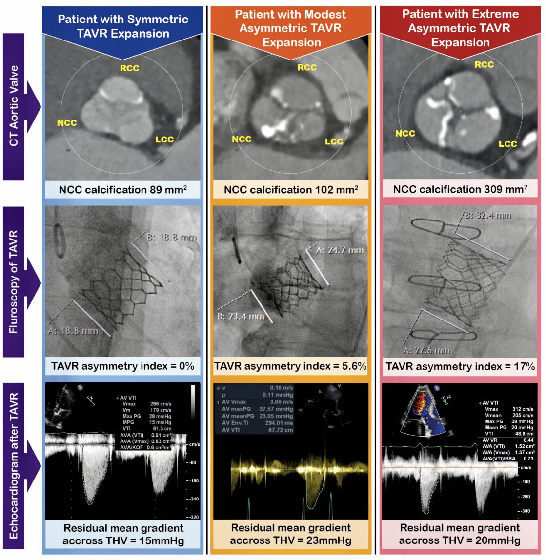 Annette Maznyczka (@amaznyczka) on Twitter photo Our latest output from Bern TAVI registry. Asymmetric expansion of balloon expandable TAVR was associated with VARC-3 impaired hemodynamic valve performance. 🙏 <a href="/ThomPilgrim/">Thomas Pilgrim</a> <a href="/DaijiroTomii/">Daijiro Tomii</a> <a href="/masaaki0825/">Masaaki Nakase</a> <a href="/pbaekke/">Pernille Bække</a> <a href="/BernCVRC/">Cardiovascular Research Cluster (CVRC)</a>
jacc.org/doi/10.1016/j.… Our latest output from Bern TAVI registry. Asymmetric expansion of balloon expandable TAVR was associated with VARC-3 impaired hemodynamic valve performance. 🙏 <a href="/ThomPilgrim/">Thomas Pilgrim</a> <a href="/DaijiroTomii/">Daijiro Tomii</a> <a href="/masaaki0825/">Masaaki Nakase</a> <a href="/pbaekke/">Pernille Bække</a> <a href="/BernCVRC/">Cardiovascular Research Cluster (CVRC)</a>
jacc.org/doi/10.1016/j.…