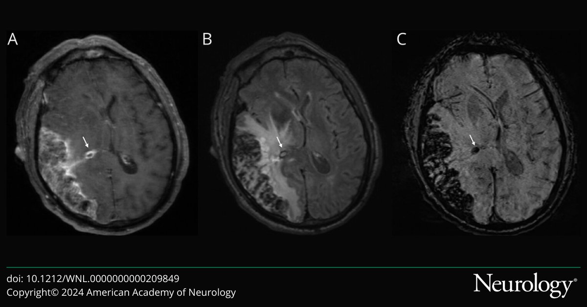 NeuroImage: Angiostrongylus Pachymeningitis and Encephalitis With Extensive Parenchymal Involvement and Lack of CSF Eosinophilia bit.ly/47eEsaf

#NeuroTwitter
