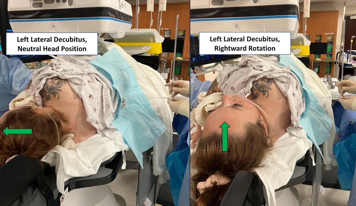 Did you know that cerebral venous pressures, trans-stenosis gradients and intracranial pressures increase with different head positions? Check out this article by Dr. Fargen! bit.ly/3ZglYE6