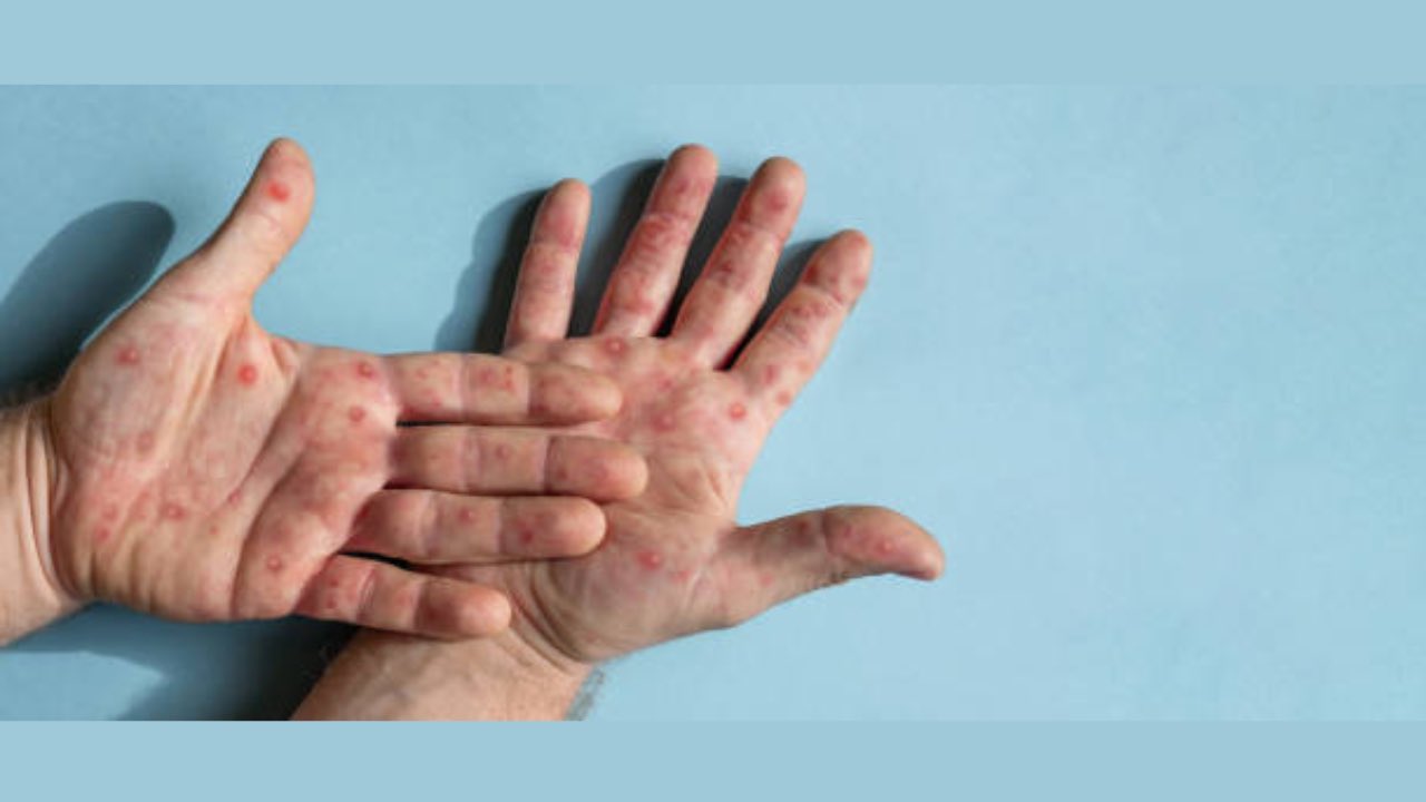 Monkeypox
