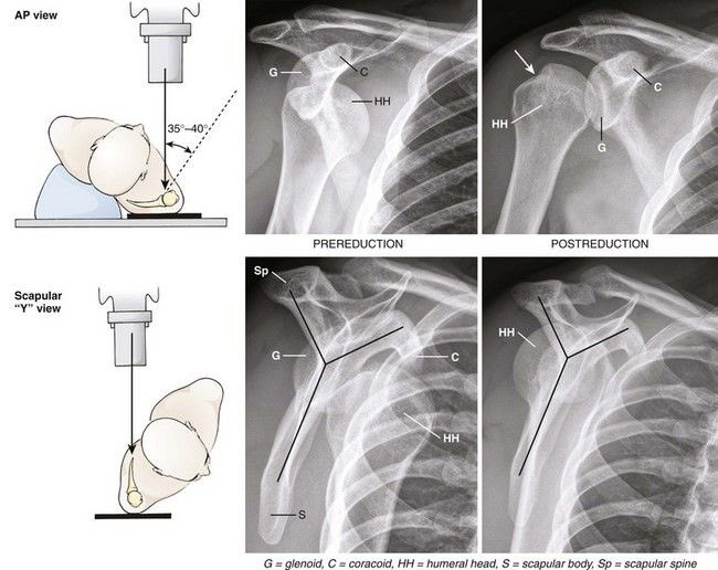 RazanAlasmari0's tweet photo. An X-ray of the shoulder is one of the most common procedures. Many patients present with chronic pain or recurrent dislocations of the joint. 

However, because X-rays provide limited information, an MRI of the shoulder is often more informative and beneficial for diagnosis. https://t.co/rwOWDVX4az