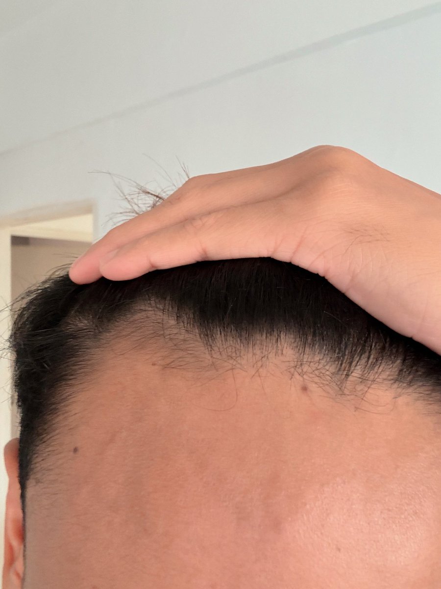 Baby hair ✨

Harini i nak share produk apa yg i pakai to finally reverse my my serious hair fall. Nombor 3 tu paling penting 🫣