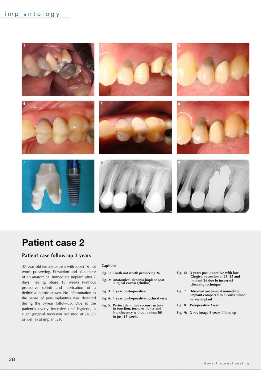 ***ARTICLE ORIGINALLY PUBLISHED IN DENTAL JOURNAL AUSTRIA 01/2016 TRANSLATED INTO ENGLISH 09/2024 FOR THOSE WHO ARE INTERESTED***