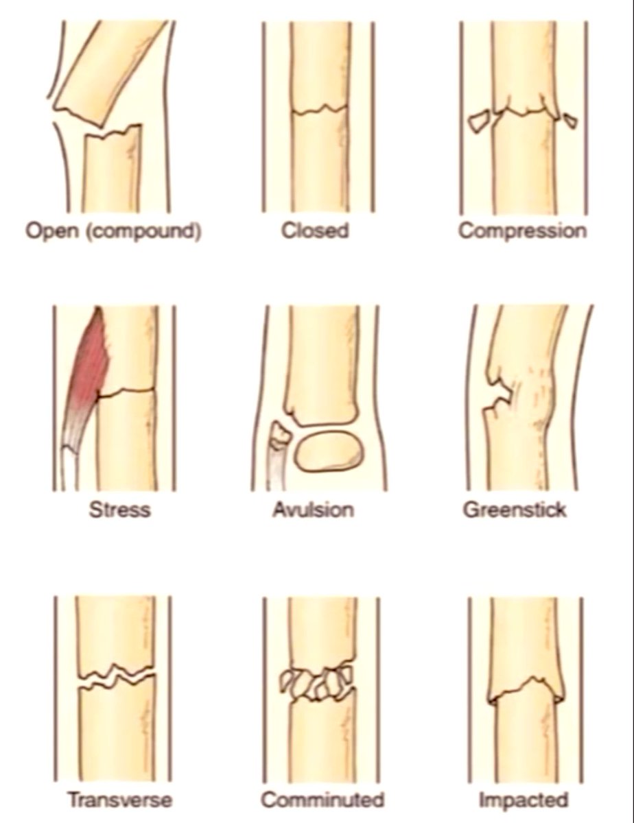 Doctors__squad's tweet photo. Different types of fracture… https://t.co/lCkrCZSUrd