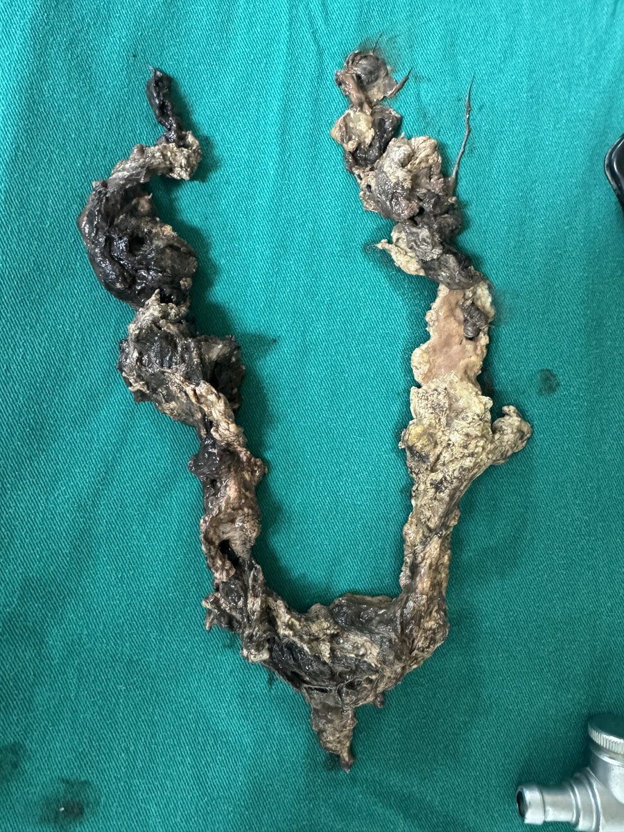 dr70ashu's tweet photo. Week 5 acute necrotizing pancreatitis with sepsis with pcd in situ. Lap pancreatic necrosectomy done. @IHPBA @EurPancClub @HpbKarolinska @Shrikhande_SV @drkeithsiau https://t.co/SLVlXKuraM