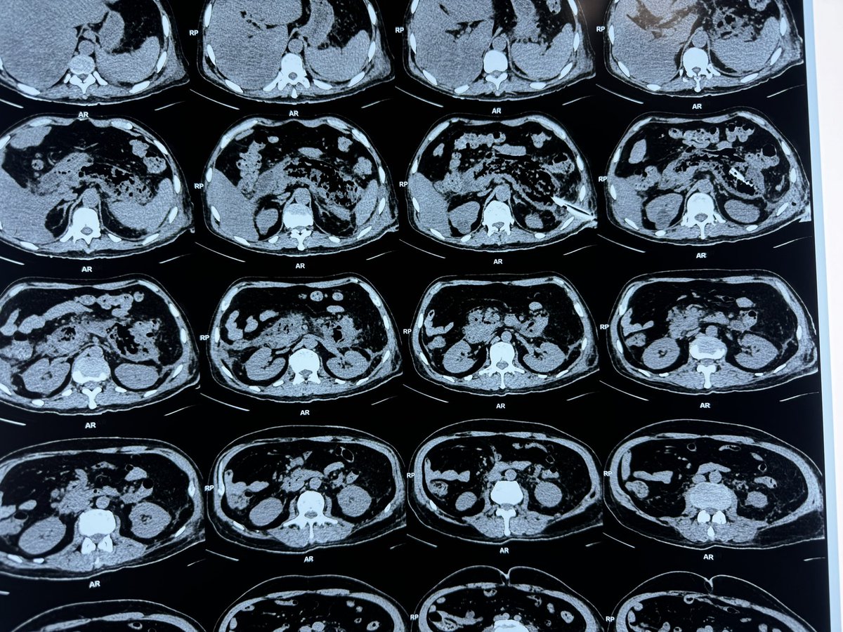 dr70ashu's tweet photo. Week 5 acute necrotizing pancreatitis with sepsis with pcd in situ. Lap pancreatic necrosectomy done. @IHPBA @EurPancClub @HpbKarolinska @Shrikhande_SV @drkeithsiau https://t.co/SLVlXKuraM