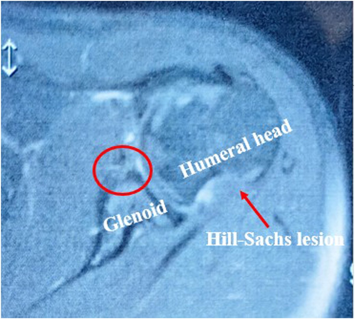 ArthroscopyJ's tweet image. All-Arthroscopic Treatment of Combined Off-Track Hill-Sachs Lesions Using Interference Screw and Shoulder Glenoid Bone Defects Using Bone Grafting With Soft Fixation #shoulder #instability #arthroscopy ow.ly/8KTB50TiljK