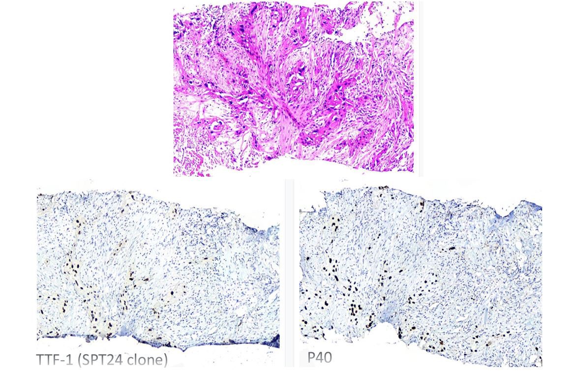 Farid Azmoudeh-Ardalan (@ardalanfarid) on Twitter photo An 84-year-old man with a solitary #lung_mass
What’s your #diagnosis?
Is it a rare case of P40 and TTF1 co-expression in a #nonsmall_cell_carcinoma or SCC with false positive reaction with #SPT40 clone?
<a href="/smlungpathguy/">Sanjay Mukhopadhyay</a> <a href="/IHC_guy/">Andrew Bellizzi 🇺🇦</a> <a href="/jahanbin_b/">B.Jahanbin</a> An 84-year-old man with a solitary #lung_mass
What’s your #diagnosis?
Is it a rare case of P40 and TTF1 co-expression in a #nonsmall_cell_carcinoma or SCC with false positive reaction with #SPT40 clone?
<a href="/smlungpathguy/">Sanjay Mukhopadhyay</a> <a href="/IHC_guy/">Andrew Bellizzi 🇺🇦</a> <a href="/jahanbin_b/">B.Jahanbin</a>