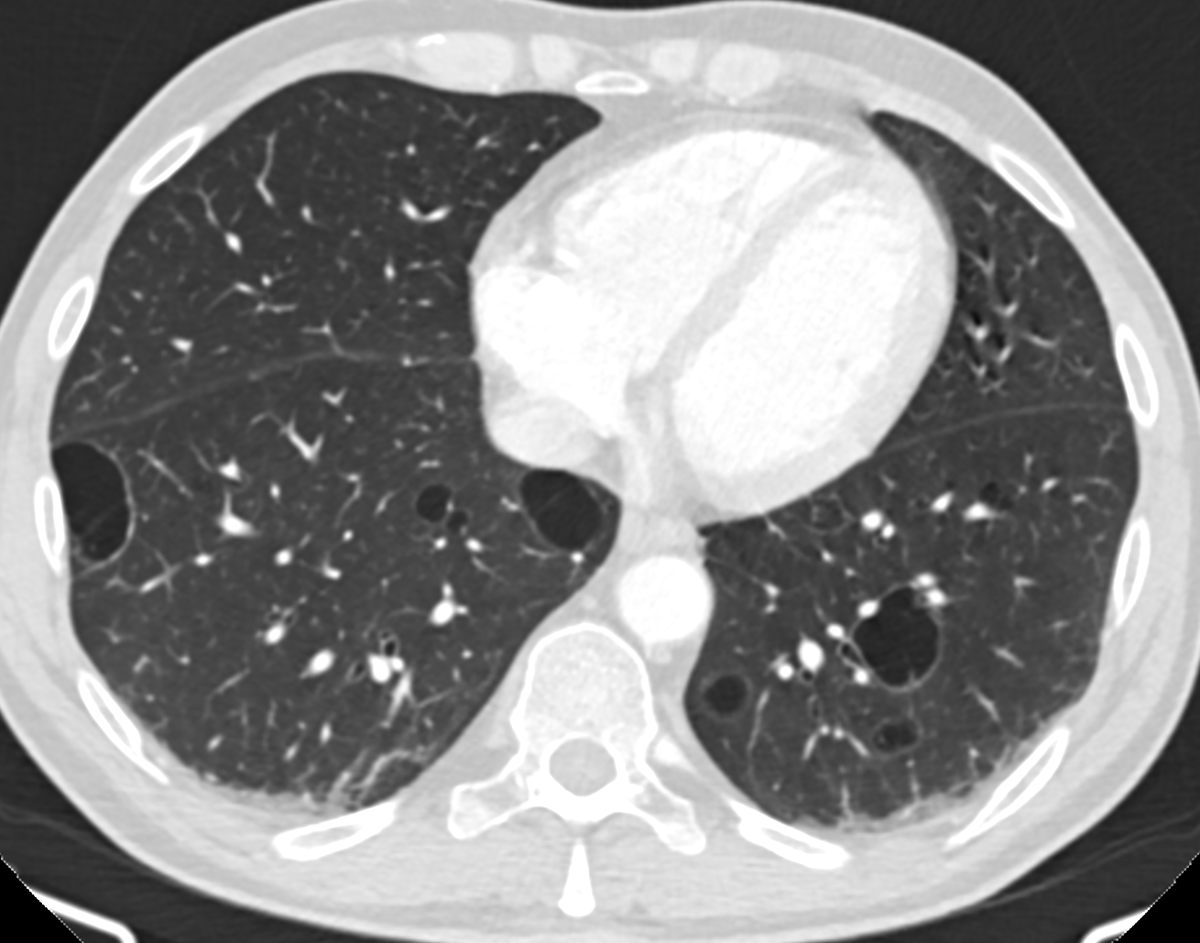 marcosmestas's tweet photo. Adult with HIV and good response to ART
No respiratory symptoms
Multiple chest CT scans due to a history of soft-tissue neoplasm

What do you think about these cysts? Any recommendation on the impression?

@howardm19 @DanielVargasMD https://t.co/TNQ1pAis63