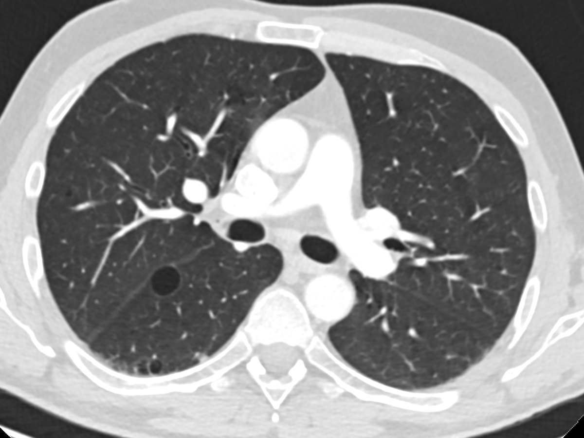 marcosmestas's tweet photo. Adult with HIV and good response to ART
No respiratory symptoms
Multiple chest CT scans due to a history of soft-tissue neoplasm

What do you think about these cysts? Any recommendation on the impression?

@howardm19 @DanielVargasMD https://t.co/TNQ1pAis63