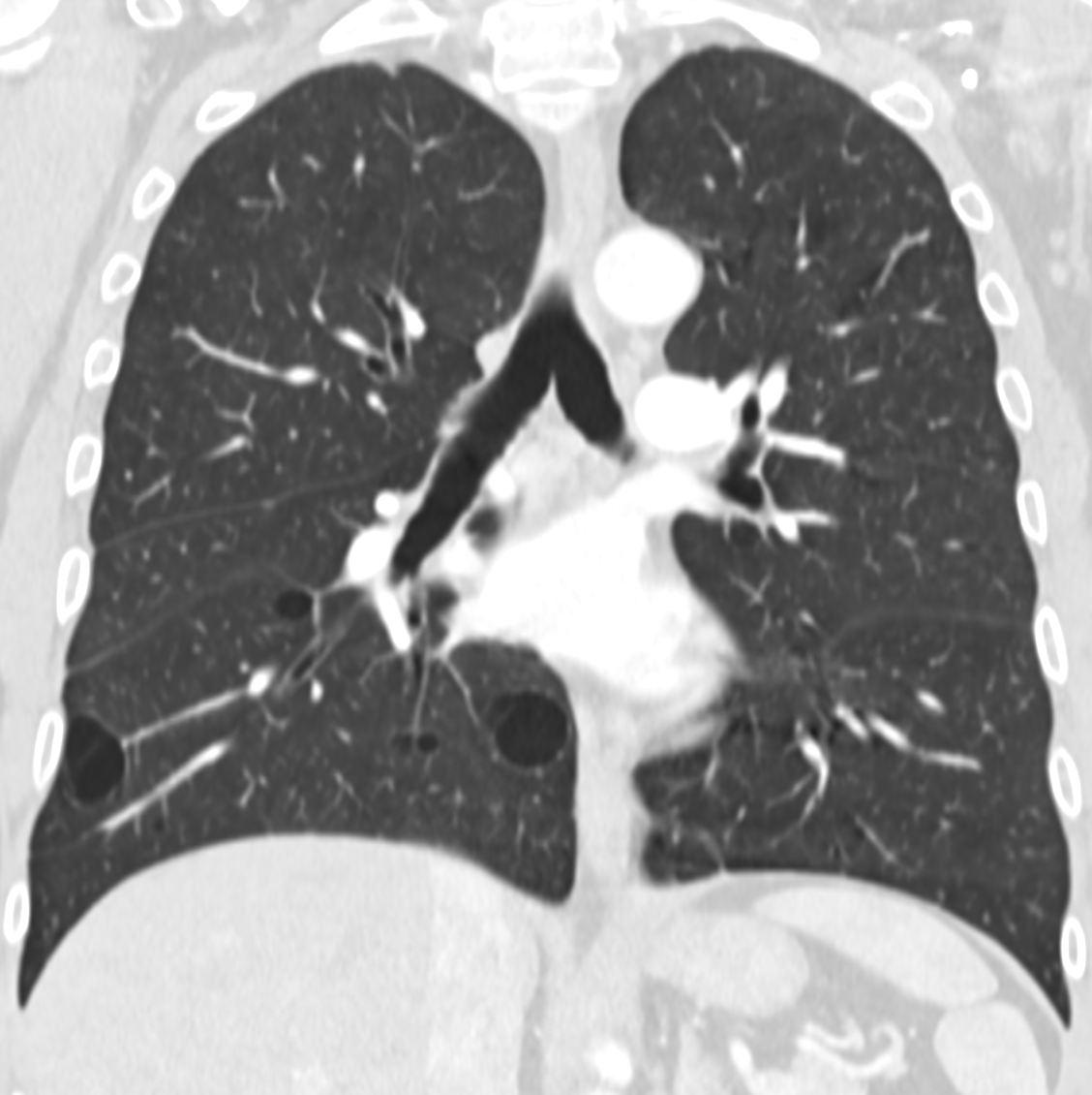 marcosmestas's tweet photo. Adult with HIV and good response to ART
No respiratory symptoms
Multiple chest CT scans due to a history of soft-tissue neoplasm

What do you think about these cysts? Any recommendation on the impression?

@howardm19 @DanielVargasMD https://t.co/TNQ1pAis63