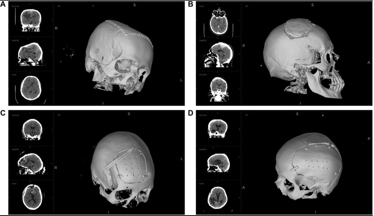 Neurosurgery Publications (@neurosurgerycns) on Twitter photo #ONSNew Template Routed Patient-Specific Implant for 1-Stage Cranioplasty bit.ly/4d4oJvw by Fahem et al Salmaniya Medical Complex @cns_update <a href="/DKondziolkaCNS/">Douglas Kondziolka</a> <a href="/george_maragkos/">George Maragkos, MD</a> <a href="/e_celano/">Emma Celano</a> <a href="/Zaazoue/">Mohamed Zaazoue</a> <a href="/urquiagajf_MD/">Jorge F. Urquiaga</a> <a href="/LKReedMD/">Laura K. Reed, MD</a> <a href="/jh_kanterMD/">John Kanter</a> #ONSNew Template Routed Patient-Specific Implant for 1-Stage Cranioplasty bit.ly/4d4oJvw by Fahem et al Salmaniya Medical Complex @cns_update <a href="/DKondziolkaCNS/">Douglas Kondziolka</a> <a href="/george_maragkos/">George Maragkos, MD</a> <a href="/e_celano/">Emma Celano</a> <a href="/Zaazoue/">Mohamed Zaazoue</a> <a href="/urquiagajf_MD/">Jorge F. Urquiaga</a> <a href="/LKReedMD/">Laura K. Reed, MD</a> <a href="/jh_kanterMD/">John Kanter</a>