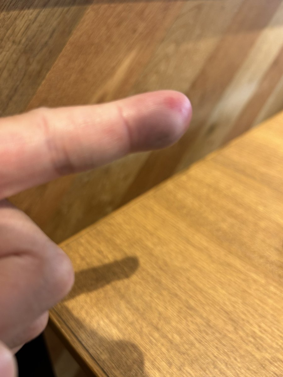 chin_uber's tweet photo. 戸越銀座付近で転倒。指が腫れ上がり激痛。配達中断。くそっ悔しい。 https://t.co/dPvONY2AXc