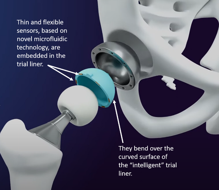 CambridgeBRC's tweet photo. Congratulations to Prof Vikas Khanduj's team across @CUH_NHS & Cambridge, who've won Β£1.4m from @NIHRResearch i4i to further develop their tech breakthrough that could transform #hipreplacements surgery @UCamEnterprise @CUH_CEI @Cambridge_Uni @cu_mat @SpringboardPro 1/2 https://t.co/4RFhRx0bUN